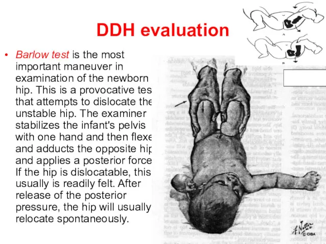 DDH evaluation Barlow test is the most important maneuver in