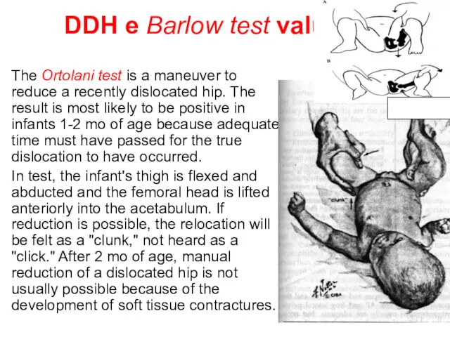 DDH e Barlow test valuation The Ortolani test is a maneuver to reduce