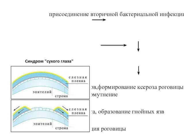 резкое снижение или полное отсутствие слезовыделения присоединение вторичной бактериальной инфекции