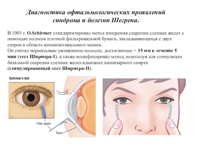 Диагностика офтальмологических проявлений синдрома и болезни Шегрена. В 1903 г.