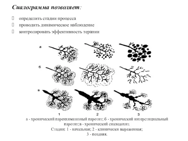 Сиалограмма позволяет: определить стадии процесса проводить динамическое наблюдение контролировать эффективность