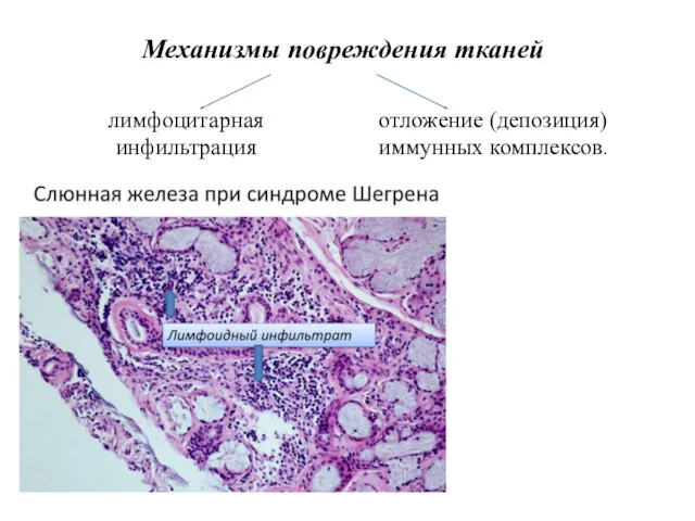 Механизмы повреждения тканей лимфоцитарная инфильтрация отложение (депозиция) иммунных комплексов.