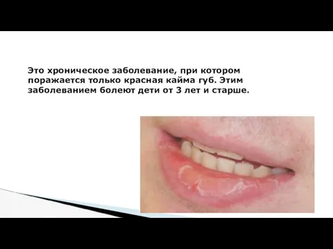 Это хроническое заболевание, при котором поражается только красная кайма губ.