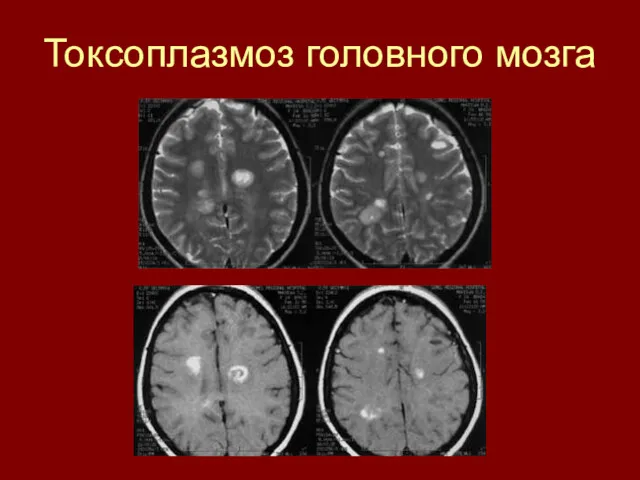 Токсоплазмоз головного мозга