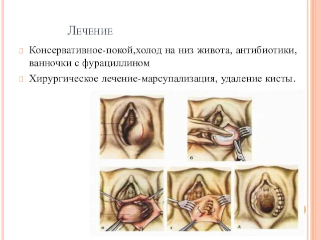 Лечение Консервативное-покой,холод на низ живота, антибиотики,ванночки с фурациллином Хирургическое лечение-марсупализация, удаление кисты.