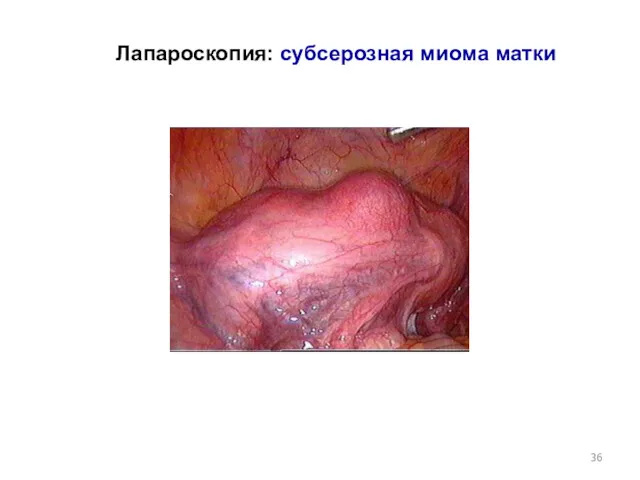 Лапароскопия: субсерозная миома матки