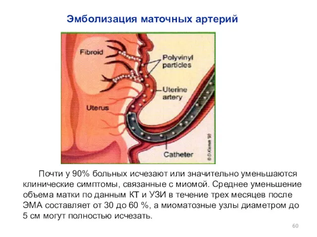 Эмболизация маточных артерий Почти у 90% больных исчезают или значительно