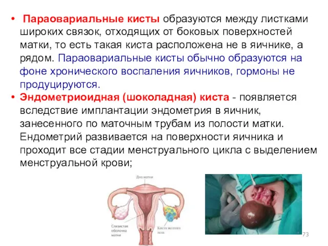 Параовариальные кисты образуются между листками широких связок, отходящих от боковых