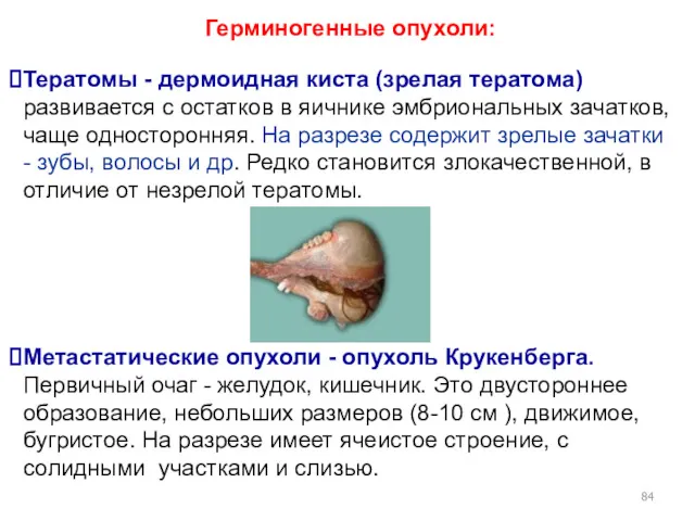 Герминогенные опухоли: Тератомы - дермоидная киста (зрелая тератома) развивается с