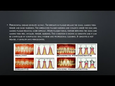 Periodontal disease develops slowly. The irritants in plaque inflame the