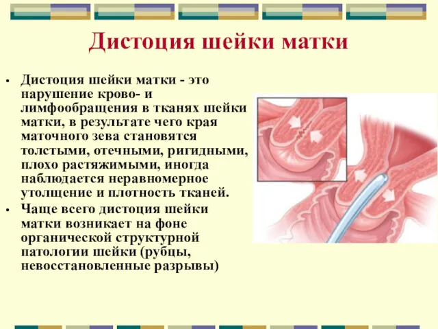 Дистоция шейки матки Дистоция шейки матки - это нарушение крово-