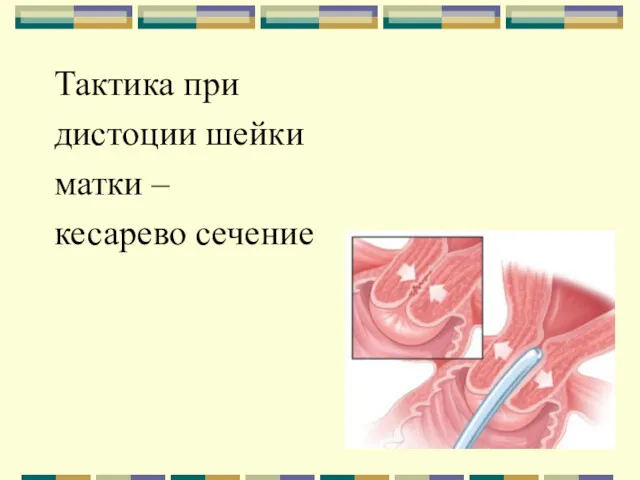 Тактика при дистоции шейки матки – кесарево сечение