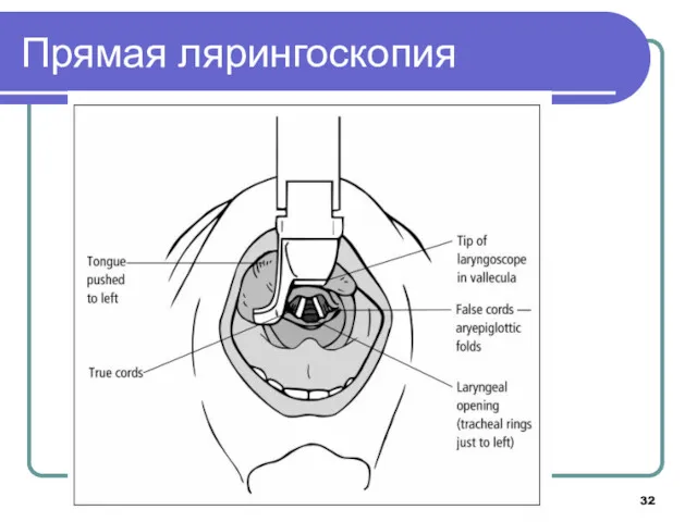 Прямая лярингоскопия