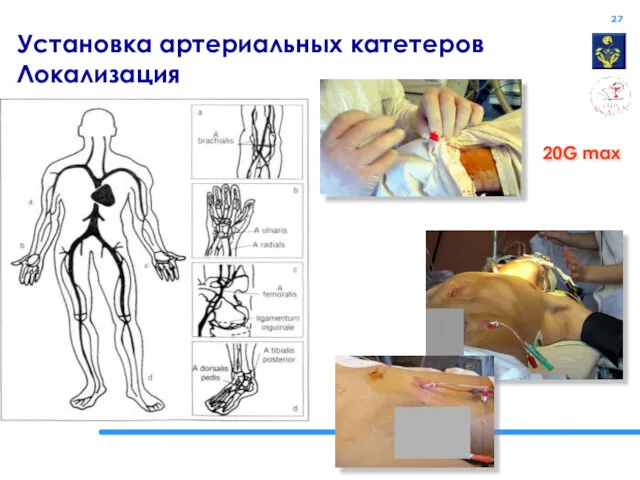 Установка артериальных катетеров Локализация 20G max