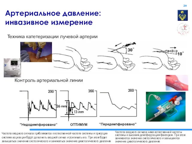 Артериальное давление: инвазивное измерение Техника катетеризации лучевой артерии Контроль артериальной