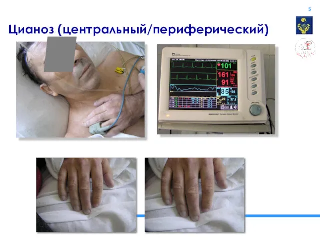 Цианоз (центральный/периферический)