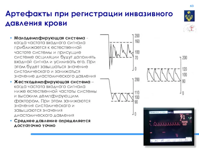 Артефакты при регистрации инвазивного давления крови Малодемпфирующая система -когда частота