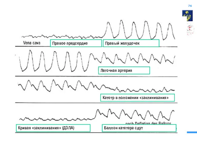 Правое предсердие Правый желудочек Легочная артерия Катетр в положении «заклинивания» Кривая «заклинивания» (ДЗЛА) Баллон катетера сдут