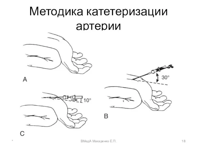 Методика катетеризации артерии * ВМедА Макаренко Е.П.