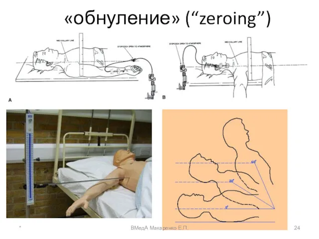 «обнуление» (“zeroing”) * ВМедА Макаренко Е.П.