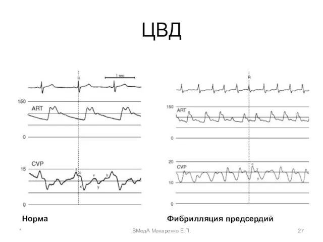 ЦВД Норма Фибрилляция предсердий * ВМедА Макаренко Е.П.