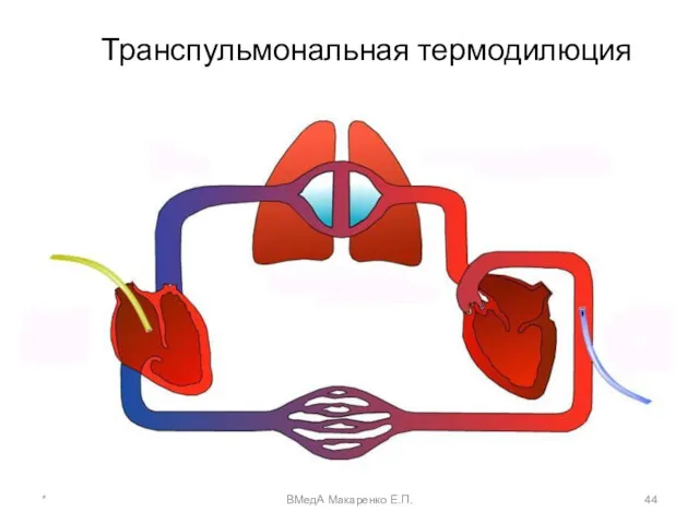 Транспульмональная термодилюция * ВМедА Макаренко Е.П.