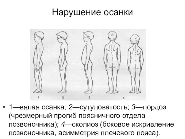 Нарушение осанки 1—вялая осанка, 2—сутуловатость; 3—лордоз (чрезмерный прогиб пояснич­ного отдела