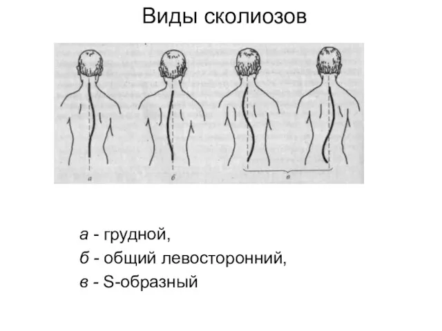 Виды сколиозов а - грудной, б - общий левосторонний, в - S-образный