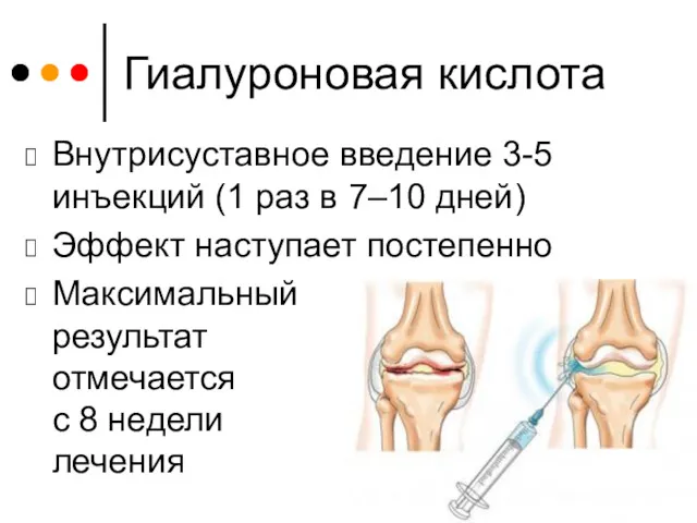 Гиалуроновая кислота Внутрисуставное введение 3-5 инъекций (1 раз в 7–10