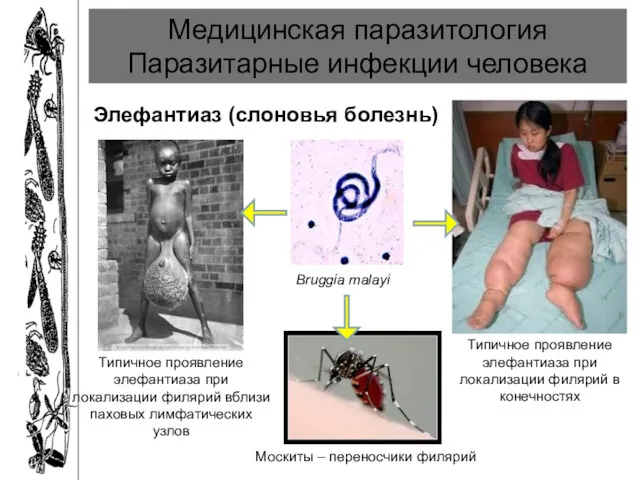 Медицинская паразитология Паразитарные инфекции человека Элефантиаз (слоновья болезнь) Bruggia malayi