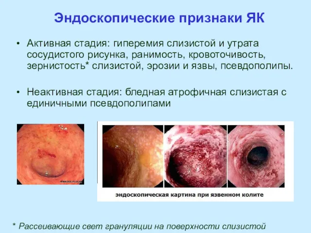 Эндоскопические признаки ЯК Активная стадия: гиперемия слизистой и утрата сосудистого