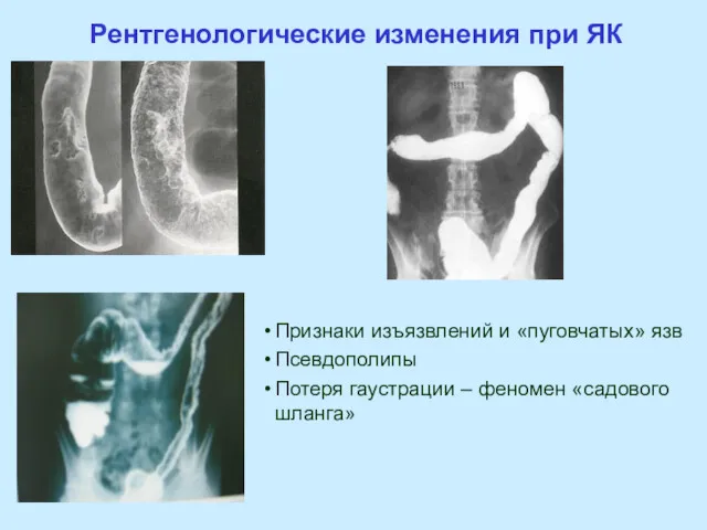 Рентгенологические изменения при ЯК Признаки изъязвлений и «пуговчатых» язв Псевдополипы Потеря гаустрации – феномен «садового шланга»