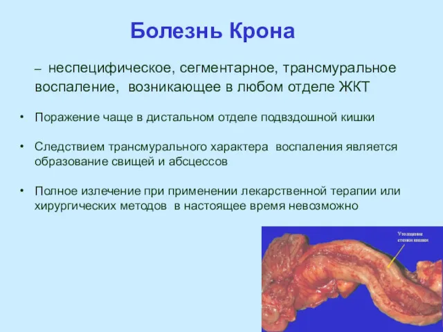 Болезнь Крона – неспецифическое, сегментарное, трансмуральное воспаление, возникающее в любом