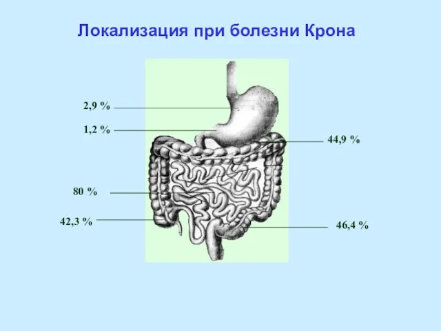 Локализация при болезни Крона