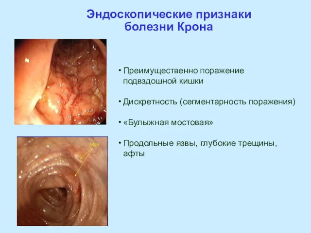 Эндоскопические признаки болезни Крона Преимущественно поражение подвздошной кишки Дискретность (сегментарность