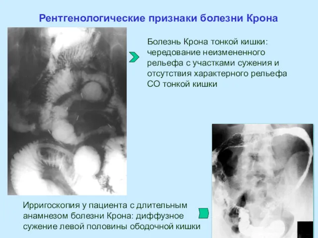 Рентгенологические признаки болезни Крона Болезнь Крона тонкой кишки: чередование неизмененного
