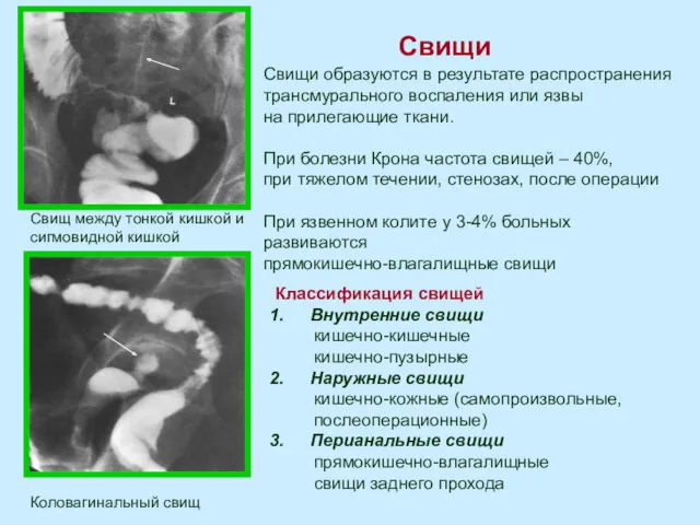 Свищи Свищ между тонкой кишкой и сигмовидной кишкой Коловагинальный свищ