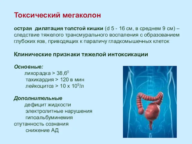 Токсический мегаколон острая дилатация толстой кишки (d 5 - 16