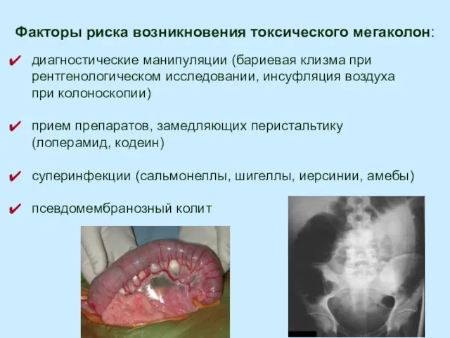 Факторы риска возникновения токсического мегаколон: диагностические манипуляции (бариевая клизма при