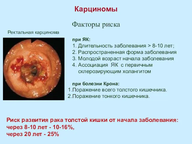 Карциномы Факторы риска при ЯК: 1. Длительность заболевания > 8-10