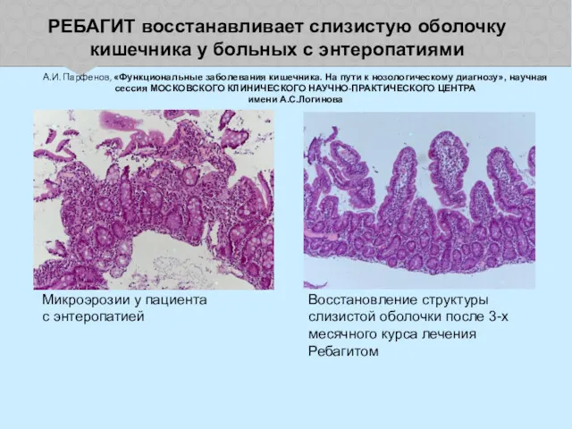 РЕБАГИТ восстанавливает слизистую оболочку кишечника у больных с энтеропатиями Микроэрозии