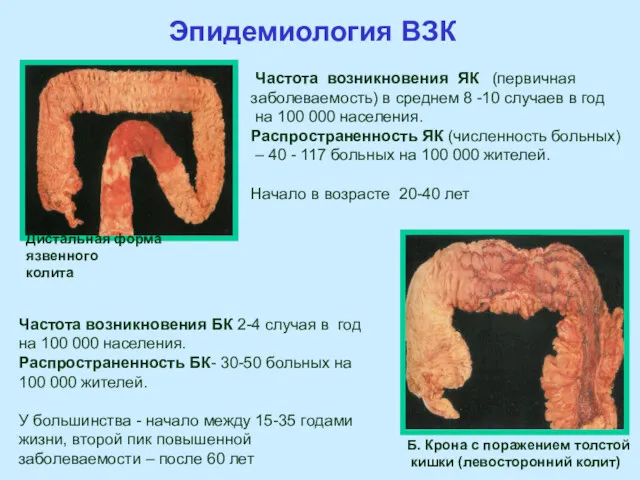 Дистальная форма язвенного колита Частота возникновения ЯК (первичная заболеваемость) в