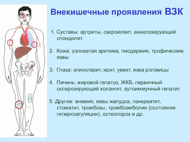 Внекишечные проявления ВЗК 1. Суставы: артриты, сакроилеит, анкилозирующий спондилит 2.