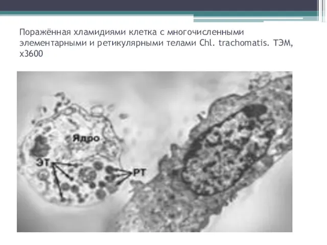 Поражённая хламидиями клетка с многочисленными элементарными и ретикулярными телами Chl. trachomatis. ТЭМ, х3600