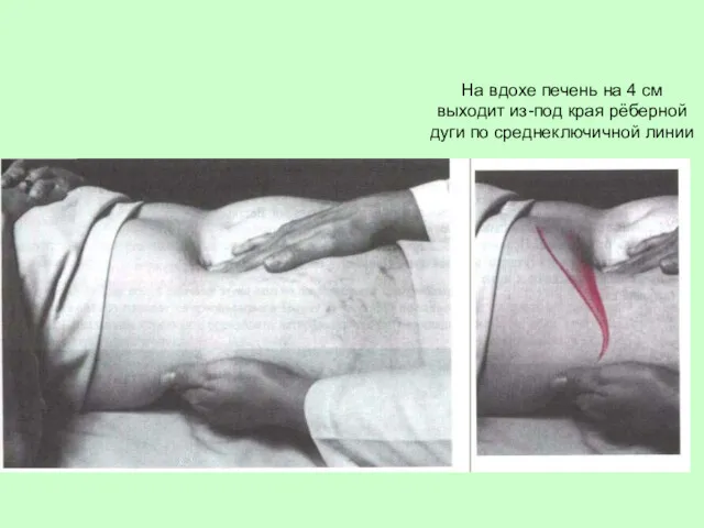 На вдохе печень на 4 см выходит из-под края рёберной дуги по среднеключичной линии