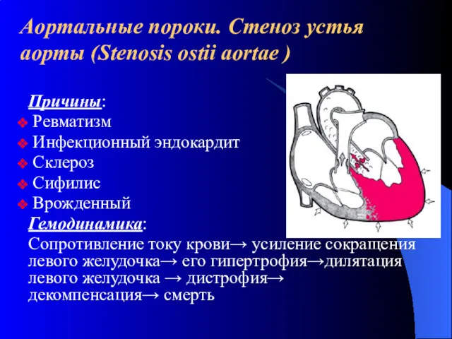 Аортальные пороки. Стеноз устья аорты (Stenosis ostii aortae ) Причины: Ревматизм Инфекционный эндокардит