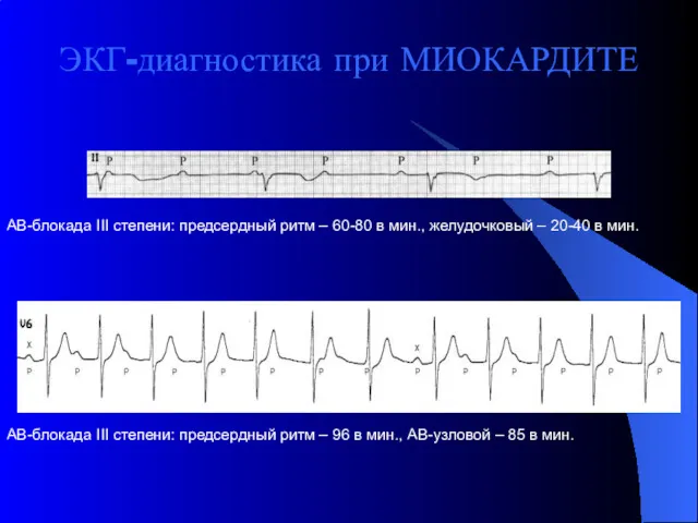 ЭКГ-диагностика при МИОКАРДИТЕ АВ-блокада III степени: предсердный ритм – 60-80 в мин., желудочковый