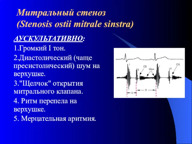 Митральный стеноз (Stenosis ostii mitrale sinstra) АУСКУЛЬТАТИВНО: 1.Громкий I тон. 2.Диастолический (чаще пресистолический)