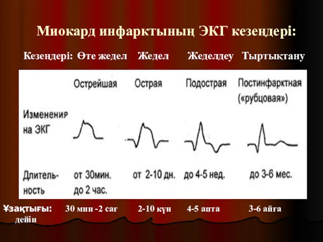 Миокард инфарктының ЭКГ кезеңдері: Кезеңдері: Өте жедел Жедел Жеделдеу Тыртықтану Ұзақтығы: 30 мин