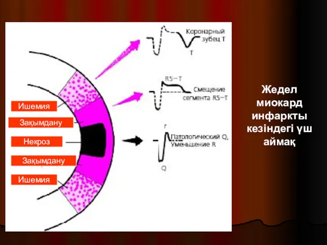 Жедел миокард инфаркты кезіндегі үш аймақ Ишемия Зақымдану Некроз Ишемия Зақымдану